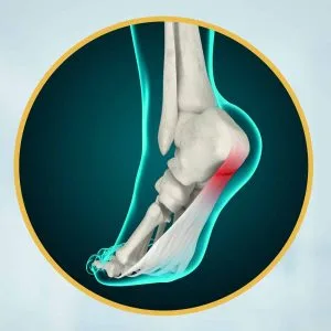 علاج الشوكة العظمية