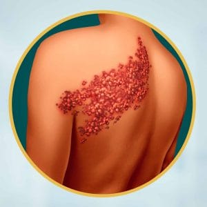 آلام الحزام الناري