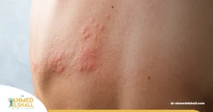 أعراض الحزام الناري